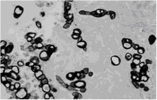 A keratotomy specimen showing a detached epithelium (top left). Large spherules of the fungus are observed in the superficial stroma (Periodic-acid-Schiff x 40) {1879}.