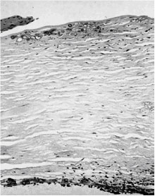 Spherules admixed with short septate hyphae are seen in the deep corneal stroma adjacent to the site of a perforation (Grocott-methenamine silver x 128) {1878}.