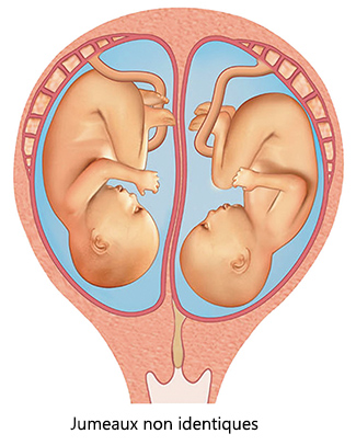Les jumeaux non identiques ont chacun un placenta